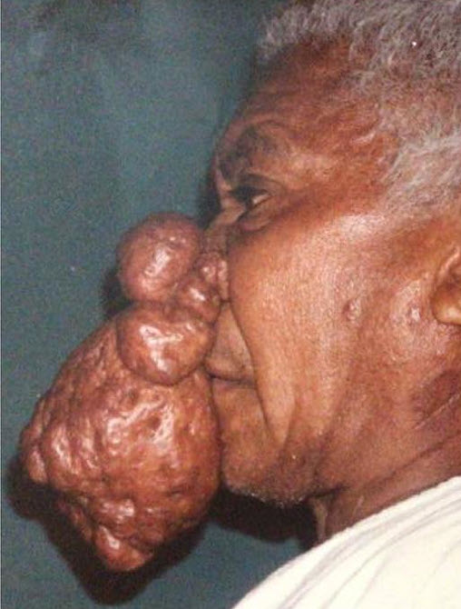 Facial